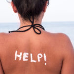 How to deal with sunburn