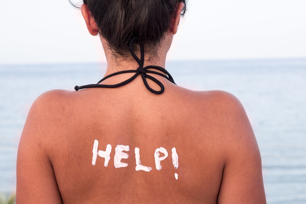 How to deal with sunburn
