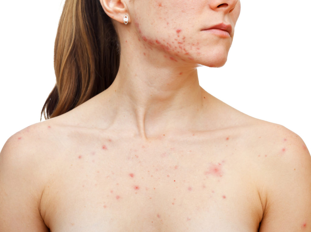 Adult acne on the face and across the chest, shoulders and back.