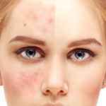 Girl with rosacea
